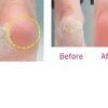 callus remover